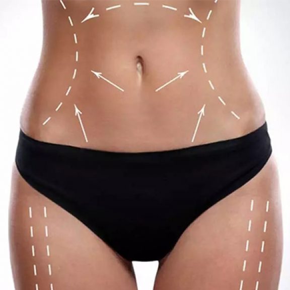 Body lift