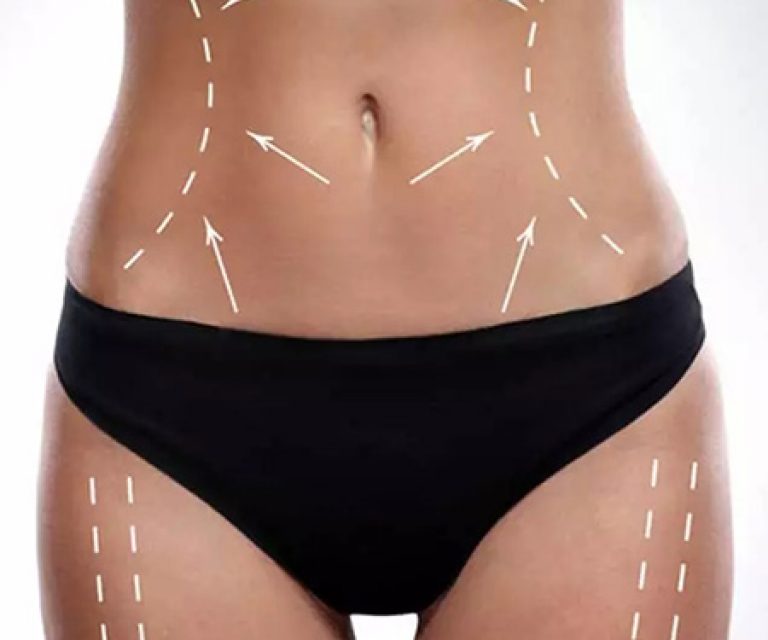 Body lift