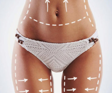 Liposuccion